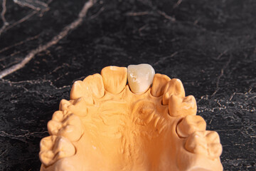 Dental implant on impressions of the mouth. Black background. Plaster cast of teeth and ceramic veneer