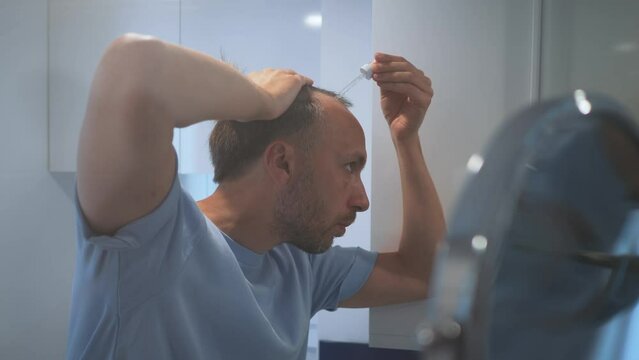 Young balding man drips with pipette strengthening serum drops on hair roots for grow stimulation and treatment at home.