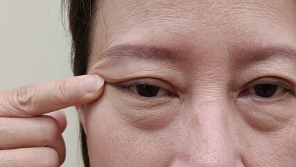 Middle-aged women have wrinkles on their faces, acne, freckles, scars on their faces.
