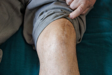 Scar on the knee from a prosthesis
