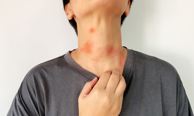Chronic urticaria or Delayed Pressure Urticaria on the neck, isolate, white background