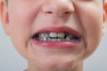 Obraz premium Cute smile of a 7-year-old boy without one baby tooth who brushed his teeth with black toothpaste