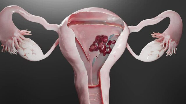Reproductive system, cancer cells, ovaries cysts, cervical cancer, growing cells, gynecological disease, metastasis cancerous, duplicating, 3d render