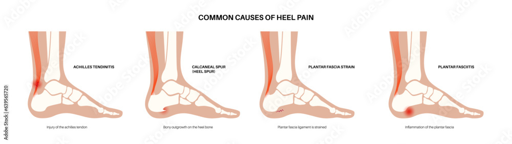 Poster heel pain diagram