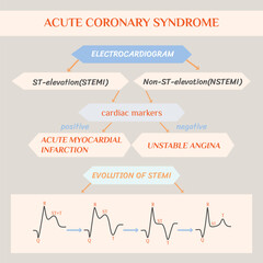 Acute coronary syndrome. Schematic Electrocardiogram of myocardial infarction (heart attack).