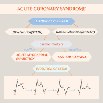 Acute coronary syndrome. Schematic Electrocardiogram of myocardial infarction (heart attack).