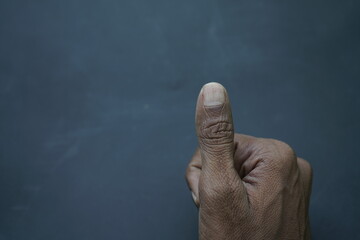 Thumb nail psoriasis , fungus on finger