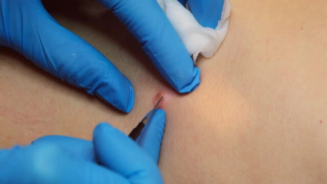 Surgeon in medical gloves using laser, removing mole on person's body. One day surgical procedure - removing papilloma or keratoma. Burned skin and wound after operation, close-up.