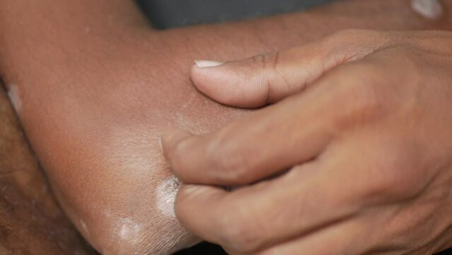 Psoriasis itches on hand elbow ,scratching skin