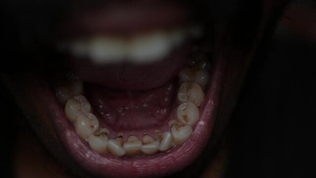 Receding gums , inner side of mouth,stain teeth ,close up view