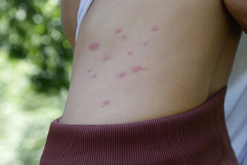 Red, swollen and itchy spots on skin caused by insect bites or allergy. Skin reaction to insect...