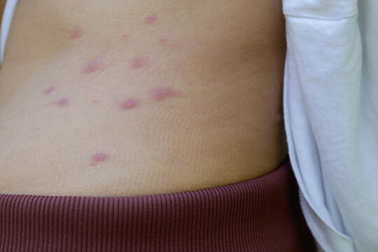 Red, swollen and itchy spots on skin caused by insect bites or allergy. Skin reaction to insect bites.