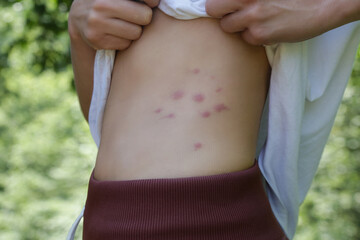 Red, swollen and itchy spots on skin caused by insect bites or allergy. Skin reaction to insect bites. - obrazy, fototapety, plakaty