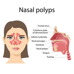 Fototapeta premium Medical vector illustration of nasal polyps. Non-cancerous neoplasms on the nasal mucosa or sinuses on a white background