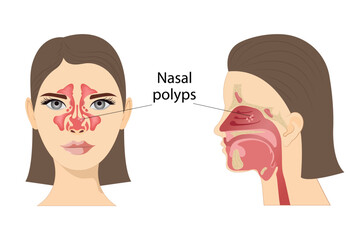 Medical vector illustration of nasal polyps. Non-cancerous neoplasms on the nasal mucosa or sinuses on a white background - obrazy, fototapety, plakaty
