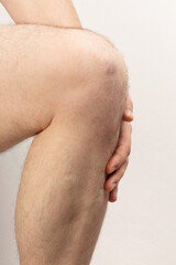 Purple hematoma on knee