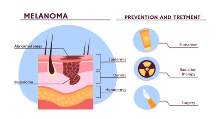 Melanoma infografics concept. Educational medical materials about disease and illness. Advices about prevention and protection. Healthcare and treatment. Cartoon flat vector illustration