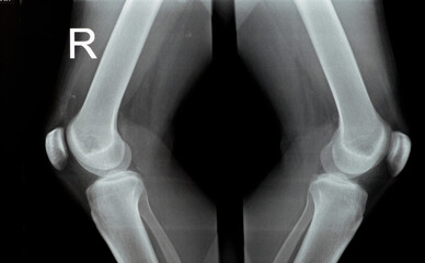 Plain X ray of both right and left knee joints with lower part of femur and upper parts of tibia...
