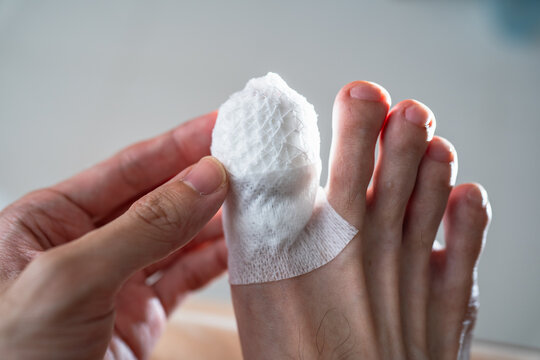 An injured toe with net bandage