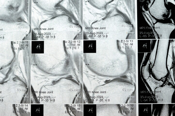 MRI of the right knee showing mild joint effusion, with normal other findings of PHMM, ACL, MCL,...