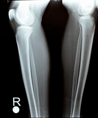 Plain X ray of both right and left knee joints with lower part of femur and upper parts of tibia...