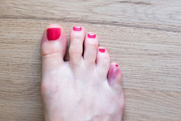 Foot with broken pinky toe caused by forceful impact with furniture. Baby toe fracture and hematoma.
