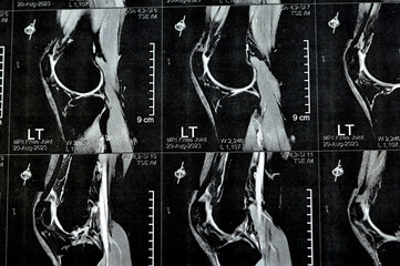 MRI of left knee joint showing minimal joint effusion, PHMM Posterior Horn Medial Meniscus...