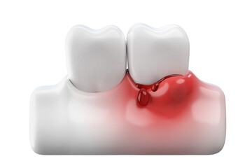 Bleeding gums and white teeth, gums disease or gingivitis concept. 3D rendering. - obrazy, fototapety, plakaty