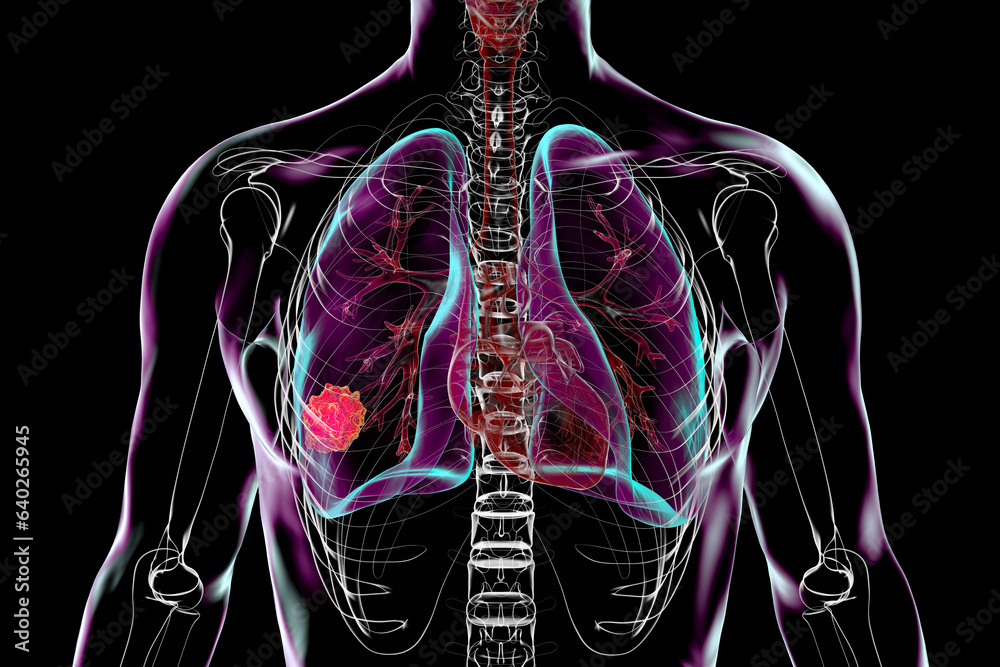 Sticker Lung cancer, 3D illustration