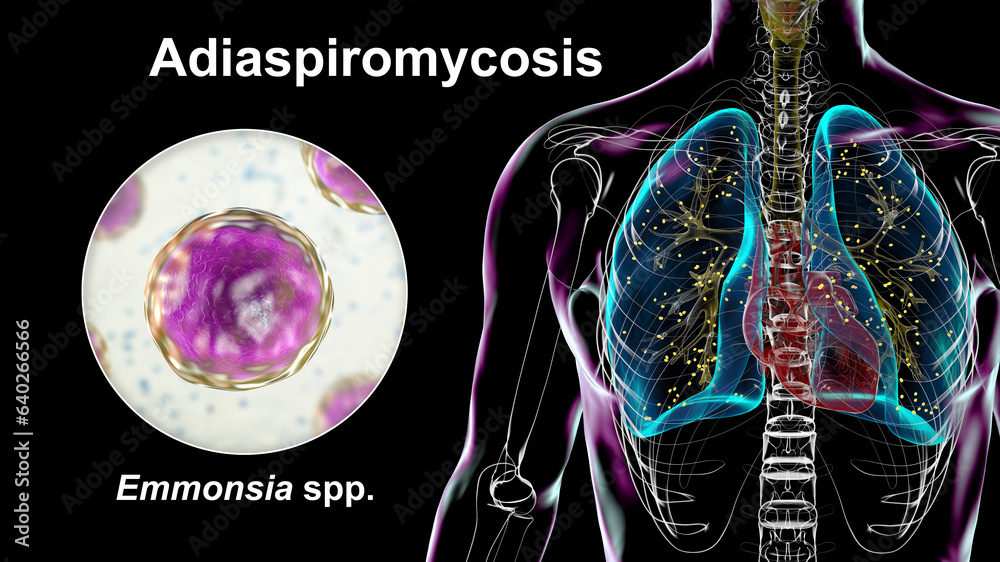 Poster Lung adiaspiromycosis and close-up view of Emmonsia fungi, 3D illustration