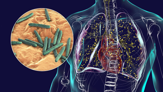 Human lungs affected by miliary tuberculosis, with a close-up view of the Mycobacterium tuberculosis bacteria, 3D illustration