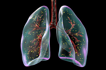 Lung adiaspiromycosis, 3D illustration