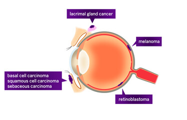 名称が記載された眼のがんのイラスト
