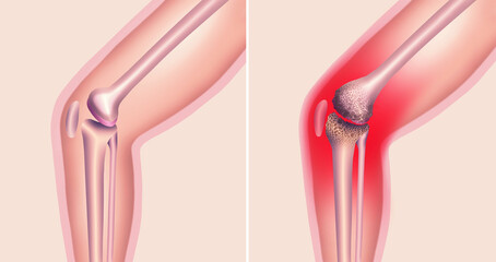 Arthrosis medical illustration diagram with damaged knee structure and healthy knee comparison.