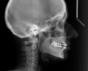 X Ray head with braces. Lateral Radiograph, used for orthodontic treatment