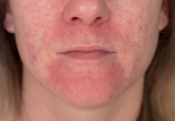 Seborrheic Dermatitis In the face of a young girl. Acne vulgaris and scars over whole face of...
