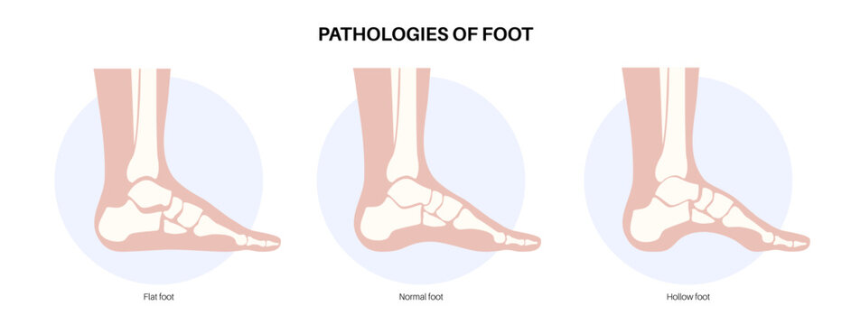 Foot pathologies poster