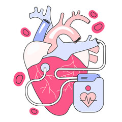 Artificial cardiac pacemaker. Medical device that generates electrical