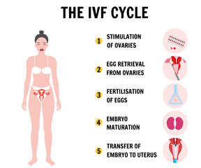 In vitro fertilization process IVF infographics and illustrations with steps 