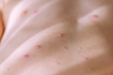 Chickenpox blisters on body of child