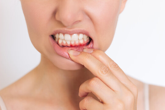 A Close-up Photo Of A Caucasian Young Woman Who Suffers From Inflammation Of The Gums On The Lower Jaw. Isolated On A White Background. Gum Health.