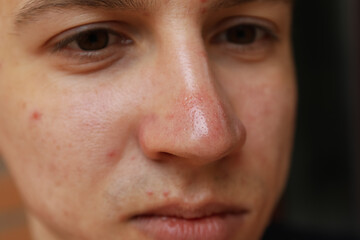 Skin condition of young man's face, close up