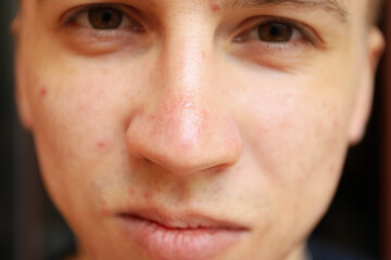 Skin condition of young man's face, close up