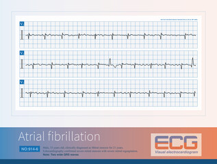 Male, 33 years old, clinically diagnosed with mitral stenosis. The rhythm displayed on the electrocardiogram is atrial fibrillation. Three electrocardiograms are continuous records.