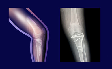 Structure of knee and rx-ray image of knee, tibia fracture with post operation internal fixation