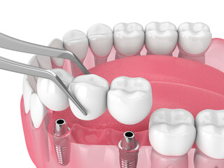 Jaw with implants supporting dental bridge over white