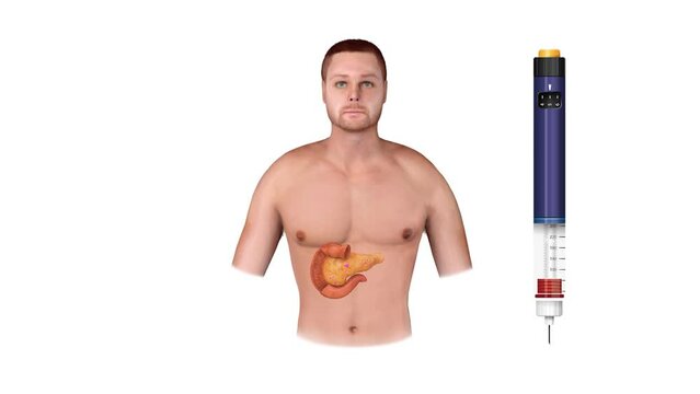 3d figure of a man , A man with diabetes making injection with insulin pen on belly, type 1 and type 2 diabetes, 3d animation,diseases, pancreas