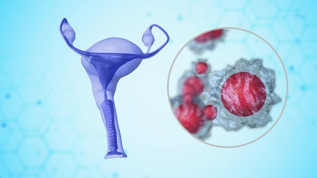 The female reproductive system's infected ovaries