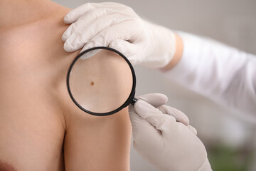 Dermatologist examining mole on young man's shoulder with magnifier in clinic, closeup