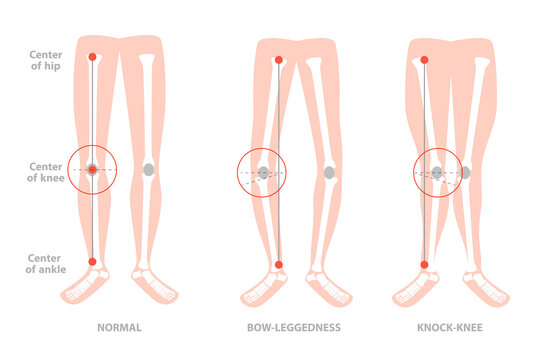 3D Isometric Flat  Conceptual Illustration of Valgus Deformity , Cosmetic Pathology